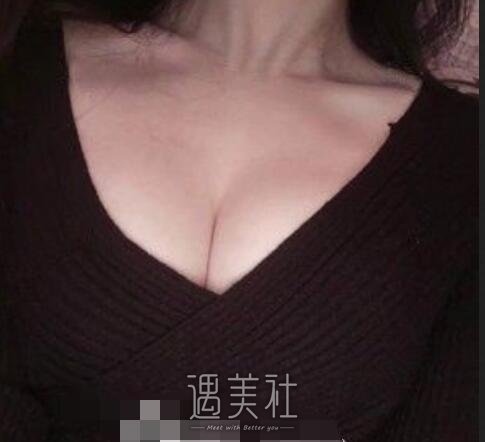 九院,余力,自体脂肪隆胸