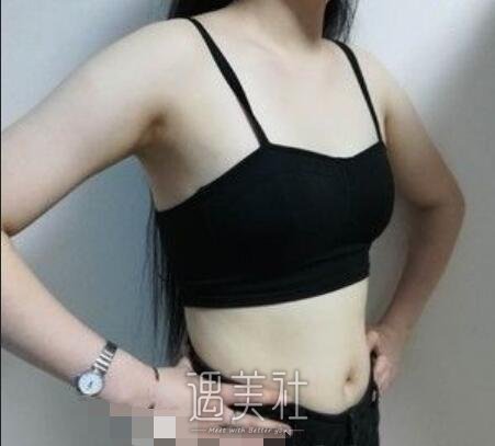 九院,余力,自体脂肪隆胸