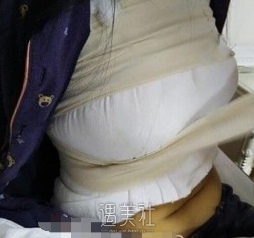 九院,余力,自体脂肪隆胸