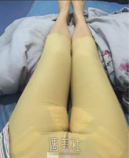 任学会,大腿吸脂