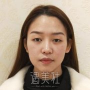 林登文割双眼皮怎么样?真实案例分享看看失败没~ width=