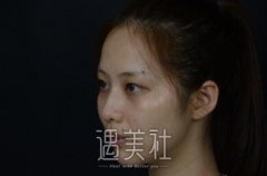 华山盛飞双眼皮案例|大大的眼睛就是有神~ width=