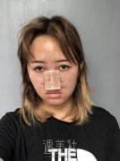 李罡医生隆鼻整形技术好吗?案例恢复图分享~ width=