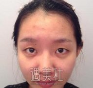 刘庆阳双眼皮技术怎么样：双眼皮案例恢复过程分享~ width=