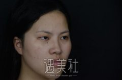 林登文割双眼皮怎么样?感觉有点好看的亚子~ width=