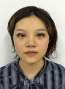 高嵩双眼皮案例：恢复过程分享~ width=