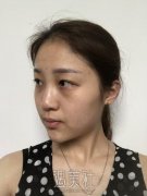 铜雀台周柯隆鼻案例：韩式隆鼻超好看~ width=
