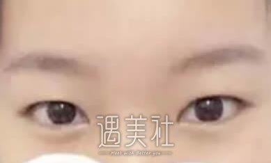 殷佳鹏,割双眼皮