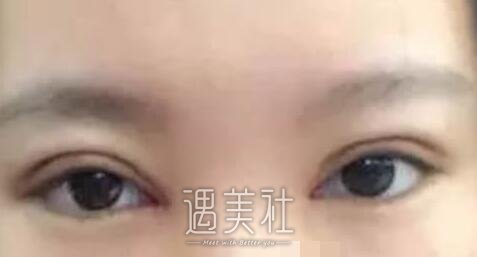殷佳鹏,割双眼皮