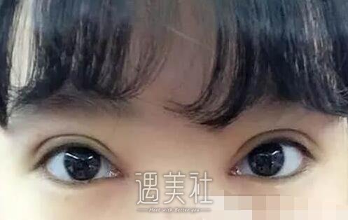 殷佳鹏,割双眼皮