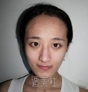 靳小雷双眼皮较近案例 想看看果呢 width=