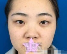 兰州梦想整形双眼皮怎么样 案例分享 width=
