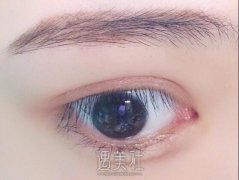 芭比双眼皮恢复后图片|芭比双眼皮优势 width=
