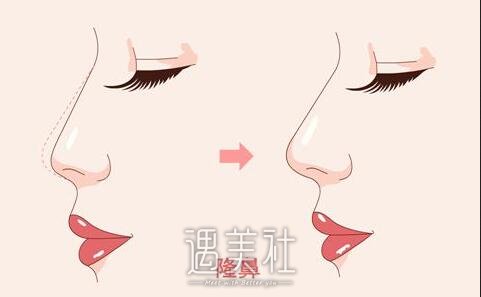 西南医院,隆鼻