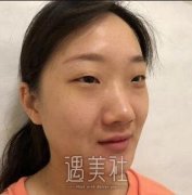 杨明峰整形双眼皮失败案例：这个真的很硬核~ width=
