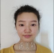 常州二院李新庆开双眼皮怎么样?有案例分享~ width=