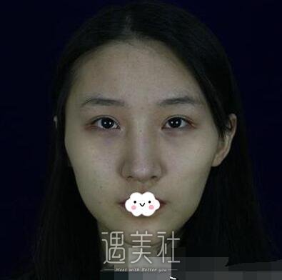 下颌角,颧骨内推