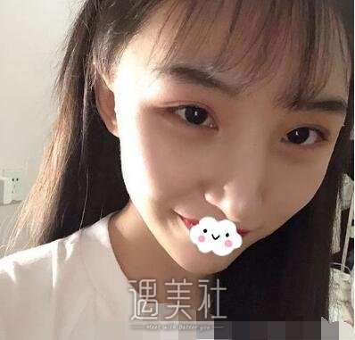 下颌角,颧骨内推