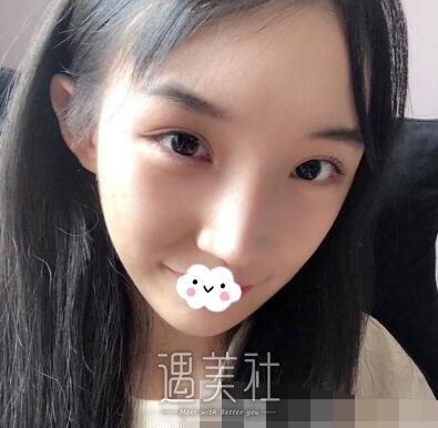下颌角,颧骨内推