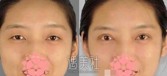 殷佳鹏,割双眼皮