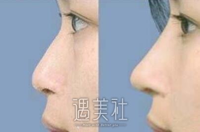 华西医院整形科,隆鼻