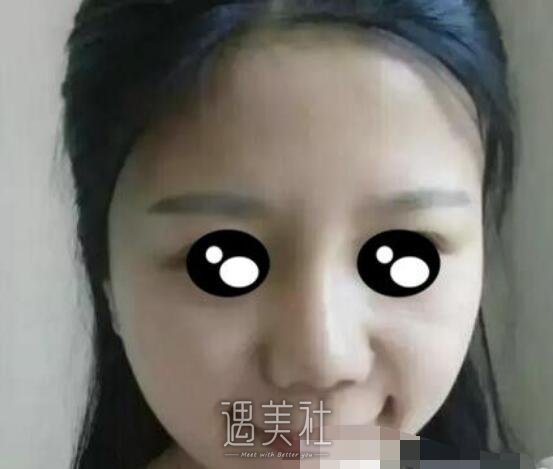 九院，韦敏，隆鼻