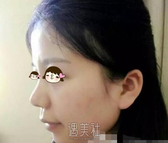 九院，韦敏，隆鼻