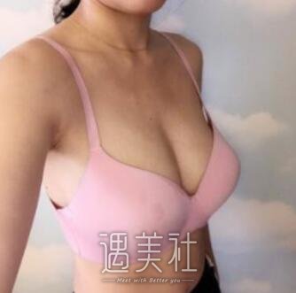 刘成胜,隆胸