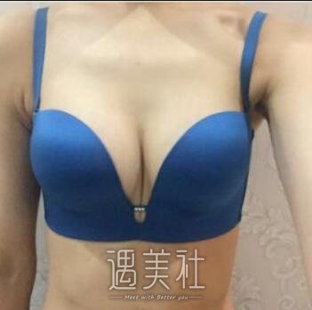刘成胜,隆胸