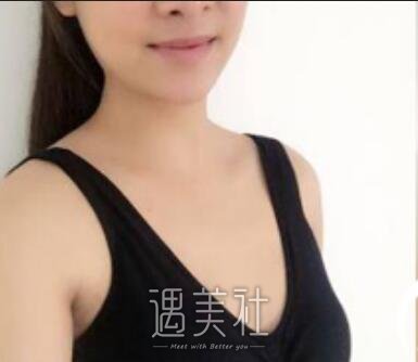 刘成胜,隆胸