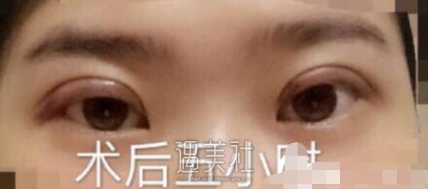 湘雅龙剑虹失败案例