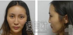 李青峰隆鼻案例图片：术后半年果图 width=