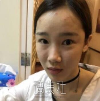 朱灿,隆鼻