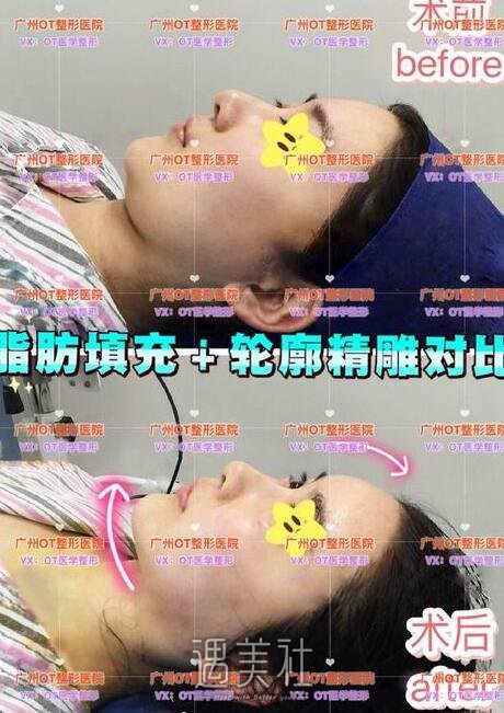 广州,ot
