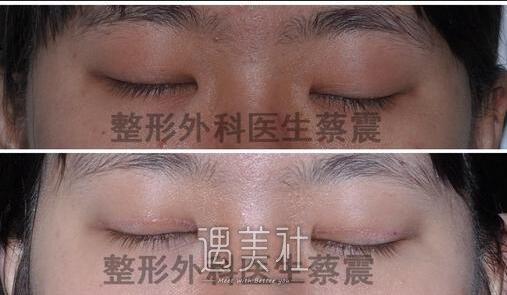 四川省人民医院整形科,蔡震