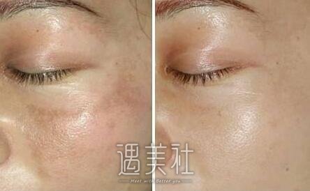 艺星,激光祛斑