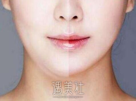 U脸吸脂