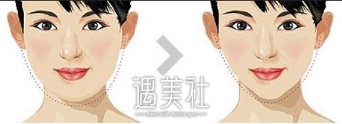 U脸吸脂