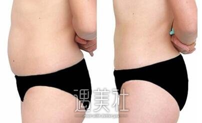 负压吸脂减肥