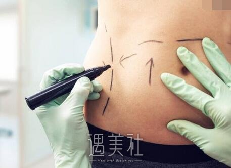 负压吸脂减肥