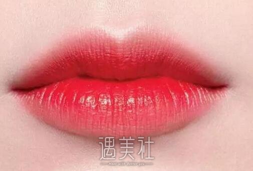 玻尿酸丰唇