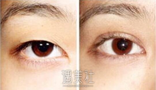 白金庄割双眼皮怎么样 价格贵吗