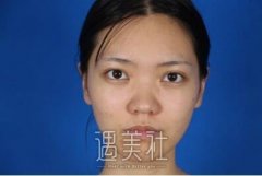 中华园整形美容李猛隆鼻失败：看案例~ width=