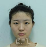 运城薛大夫整形案例：割双眼皮术前术后对比图~ width=