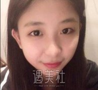 西京医院双眼皮案例：前后恢复对比~ width=
