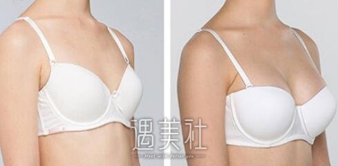 马桂娥,自体脂肪隆胸