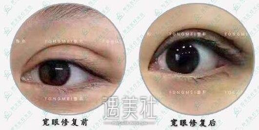 刘风卓,修复双眼皮