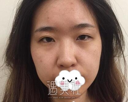 余东,双眼皮修复失败