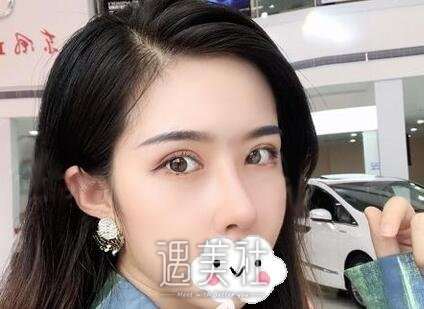余东,双眼皮修复失败