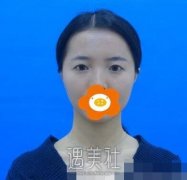 江北刘菲双眼皮案例：一个月恢复记录 width=